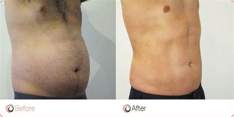 The most common causes are trapped gas or eating too much in a short time. . Bulge above belly button after lipo
